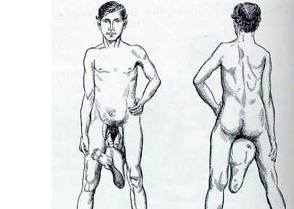 世界十大怪胎 拥有两个阴茎的男人