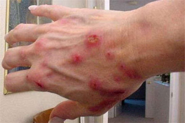 世界十大治不愈的病 普通感冒上榜,第四让人感觉有虫子在咬皮肤